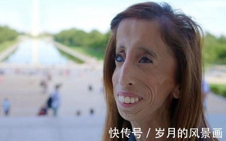 纪录|曾破吉尼斯最瘦纪录的骷髅女孩,只有27公斤,如今成励志女孩