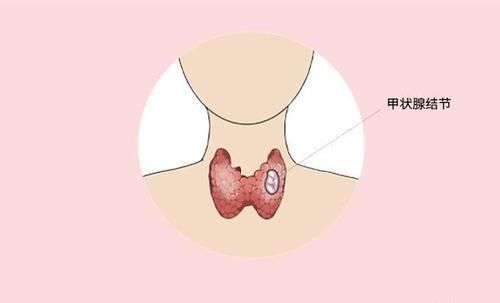 良性|13mm甲状腺结节，半年变成癌，医生：2种结节较危险，尽早处理