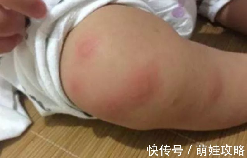 宝宝|宝宝被蚊子叮咬后,第一步不是帮娃止痒,很多家长都做错了