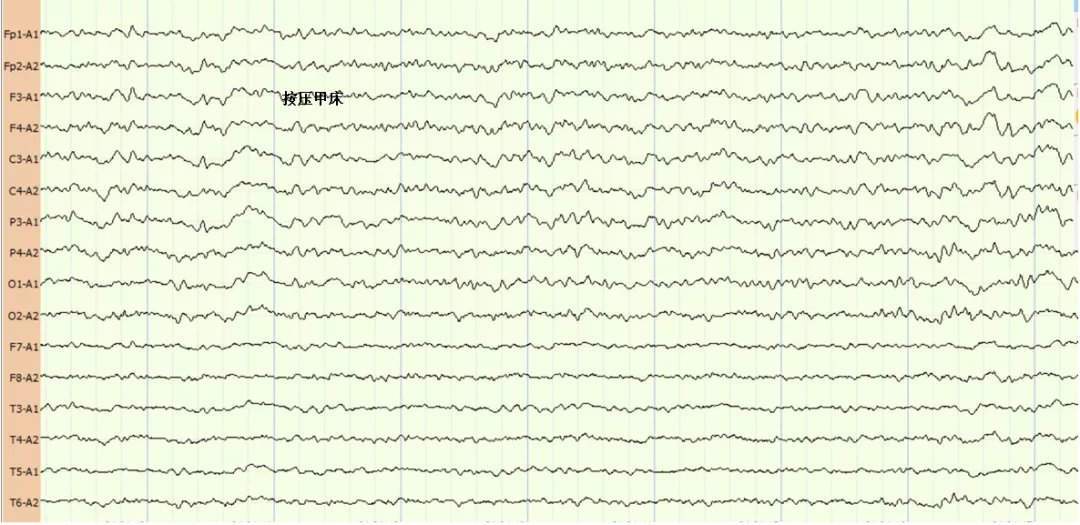 心跳骤停|医生,我爸还能醒吗?会不会变成植物人?