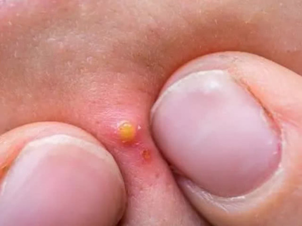 天天和螨虫睡长痘痘仅需要一片叶子,螨虫全部“一只不剩”