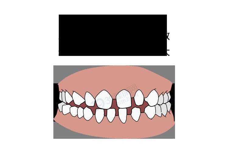 矫正|为什么只要戴牙套，牙齿就可以恢复得很整齐？生动展示矫正过程
