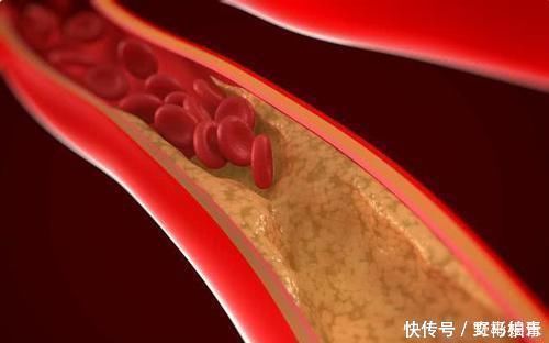 黑木耳|天然“降脂药”被发现了，坚持每天吃，帮你“吃”掉血脂通血管