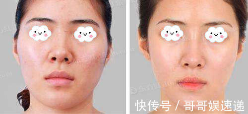 隆鼻|鼻部整形真的安全吗?假体隆鼻材料硅胶和膨体哪个更自然持久?