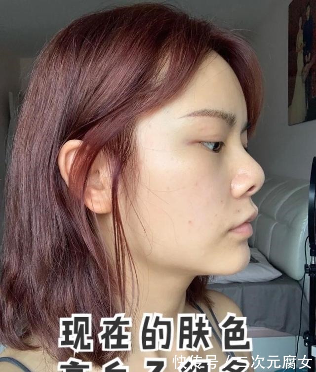肤色 经常做光子嫩肤的人,皮肤后来怎么样了!
