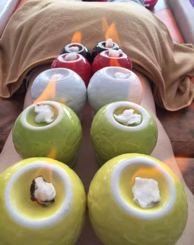  好处|拔火罐居然会有那么多好处，也有三大误区，一件事一定不能做！