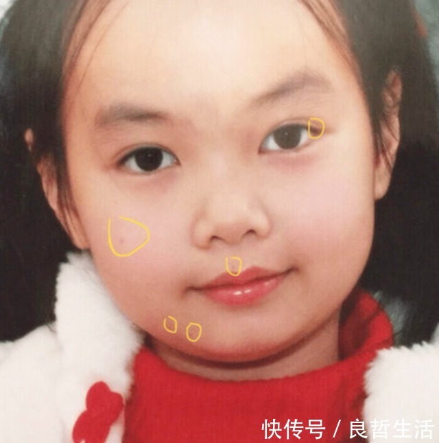 福气|孩子身体这几个部位有痣,可能是有福气的表现,你家娃中了没