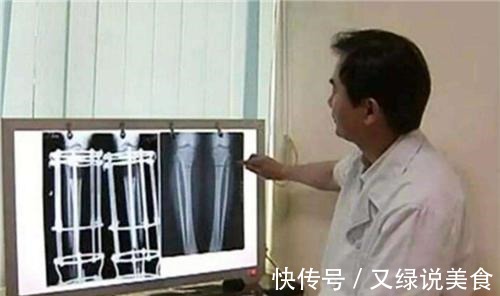 李亚诺|男子因矮身高自卑,花16万断骨增高7.2厘米的李亚诺,结果如何了