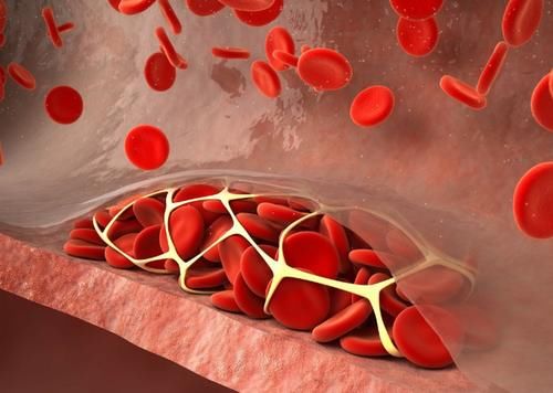 胆固醇|血脂高是面条吃多了？医生：想平稳血脂，尽量少吃2种食物