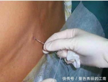 剖腹产|剖腹产麻醉后,产妇有啥感觉,看经历过的妈妈们怎么说