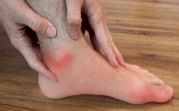 症状|高尿酸是诱发痛风的前提，两个方法教你稳住！