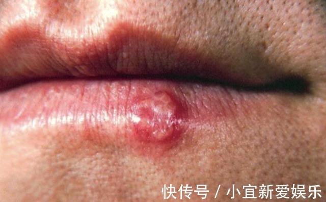 身体|嘴上长泡是身体在排毒吗？或许是暗示了这几个问题，别忽视