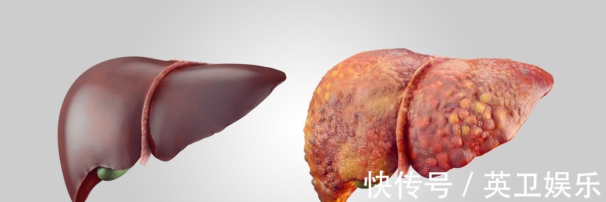 肝功能|手掌胸部出现这些表现,立即去医院查查肝,是肝硬化的前期表现