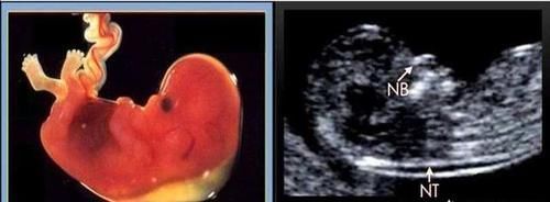 鼻骨|孕23周＋2四维显示无鼻骨，做唐筛NT低风险，孩子能留吗？