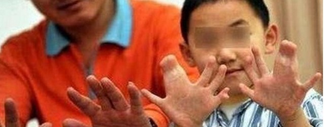 吉尼斯世界纪录|小孩指头竟有34个,打破了吉尼斯世界纪录