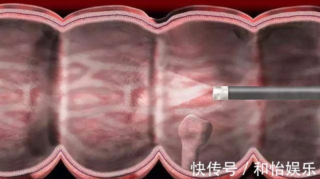 器质性便秘|四天一次大便是大肠癌吗，医生提醒，上厕所时三个信号才最关键