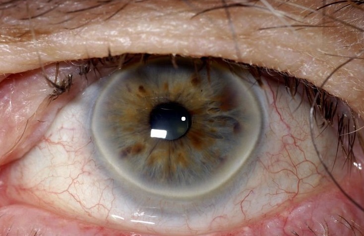 高血脂|37岁男子胸闷,检查确诊高血脂,医生直言:1早餐是升血脂的“元凶”