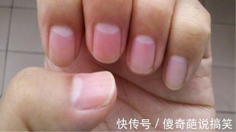 健康|指甲上没有月牙就代表不健康?不完全正确!