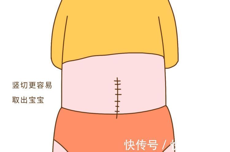 生产方式|剖腹产横切和纵切有什么区别?打算剖腹产的孕妇,要认真做选择