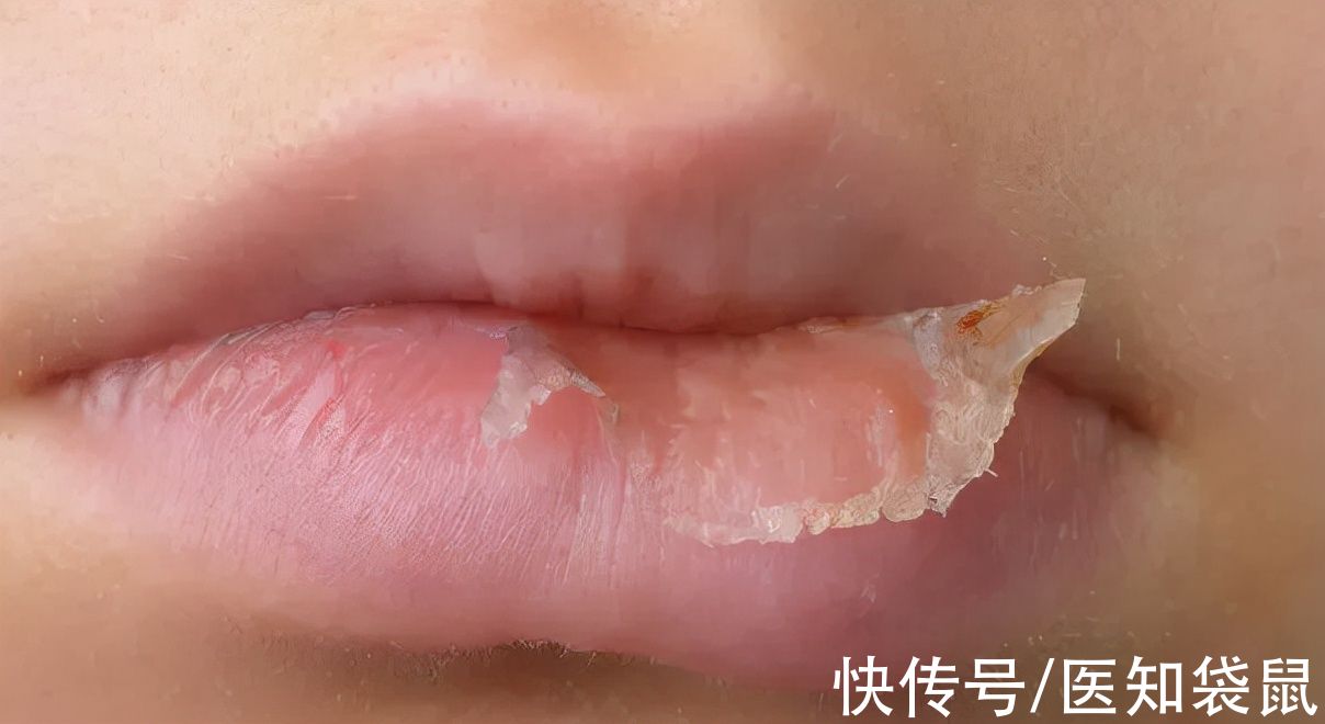 保湿|孩子总是舔嘴唇？当心唇炎找上门