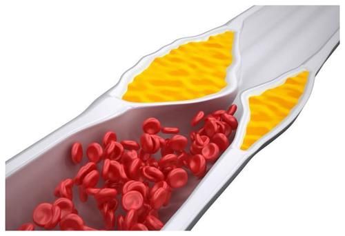 过度肥胖|统计可知：高血脂“元凶”可归纳为这5点，早知道早预防