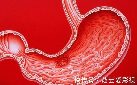 黏膜|医生提示:看似是小病,其实是癌前病变,这4种病,很少人放心上