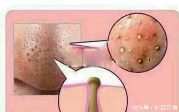 该拿黑头咋办?用四种方法拔掉它,要变美(内含错误的护理方法)
