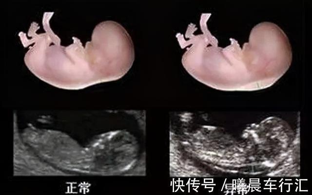 nt|世界唐氏综合征日：三类孕妇易怀“唐氏儿”，两项产检筛查很关键