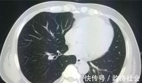 胸膜|癌症病人的幸运指数不一样，这位老太太想感谢一个吹破的肺大泡