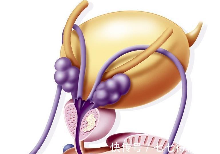 炎症|男人不想“生命腺”受困扰,4个“不”字要牢记,多吃3物!