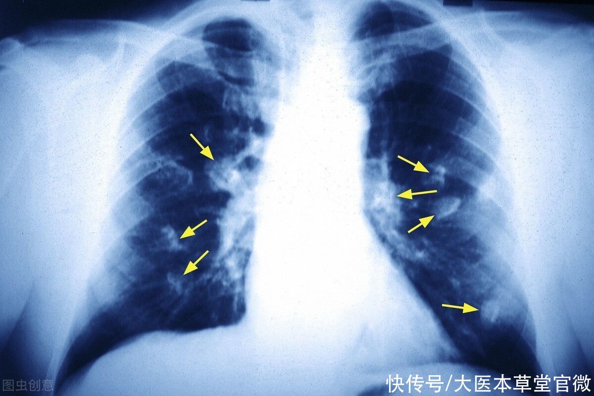 手术切除|治疗肺癌，中医效果好还是西医效果好？