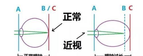 激光类|近视给生活带来不便，这些方法帮您烦恼……