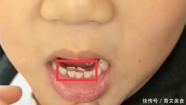 孩子|6岁男孩长出“双排牙”,要一颗颗拔掉,妈妈自责不已,都怪我