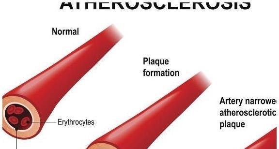 脑中风|血脂高对身体危害大，许多人体检才知道，你知道血脂高的征兆吗？