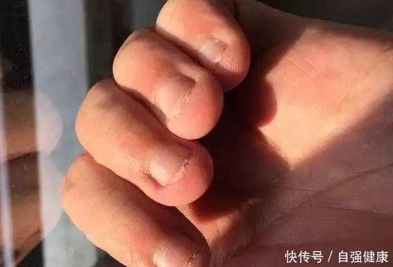 指甲|14岁女孩咬指甲的心理原因，啃指甲有什么办法治疗？