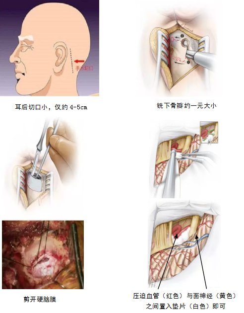 小脑|左眼跳财，右眼跳灾？不管哪边跳，都要当心这种疾病！