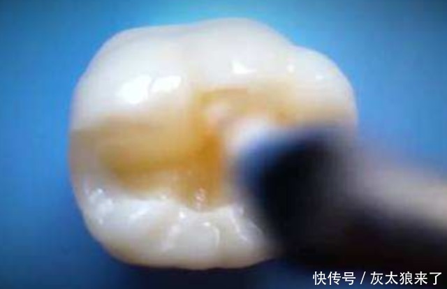 蛀牙真是被“蛀虫”咬的吗?3D动画演示全程,看着都感觉疼!