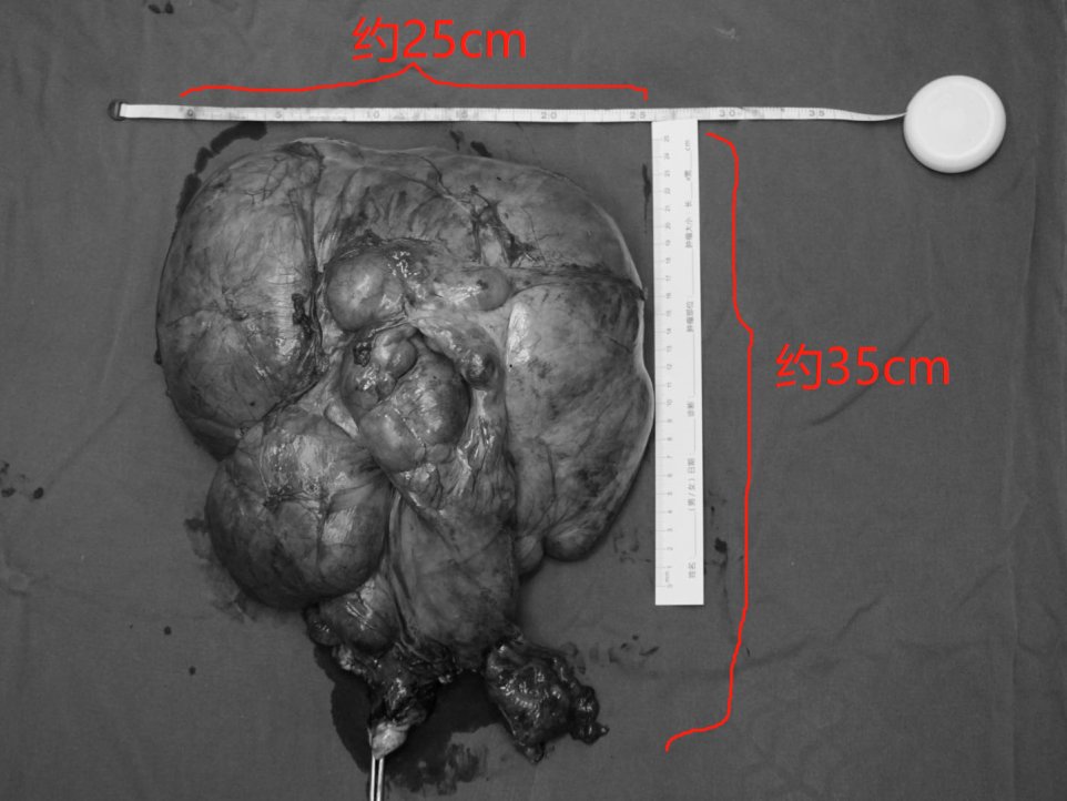 血管|“子宫肌瘤”9斤重，顺着血管长进心脏，14个学科联手，16个小时成功摘瘤
