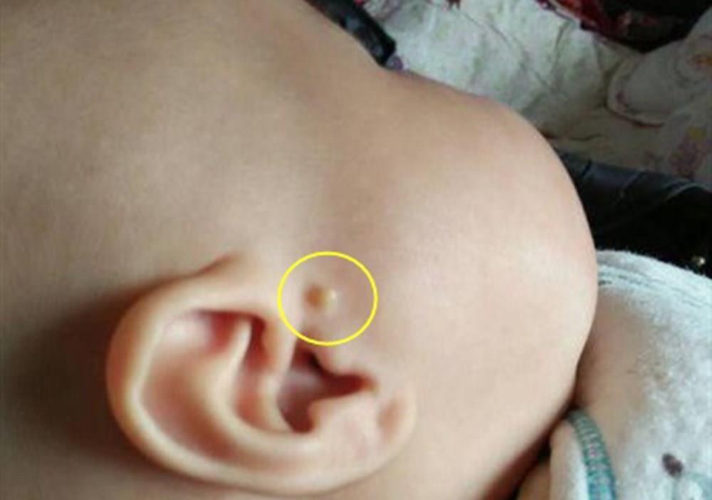 耳边多“肉揪”，孩子理发被嘲笑，耳有“拴马桩”是福气的象征？