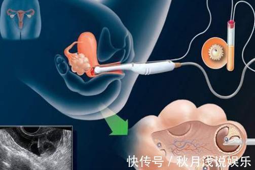 试管婴儿|做试管婴儿究竟有多疼?看完才知道当妈妈多不容易,赶紧孝顺吧!