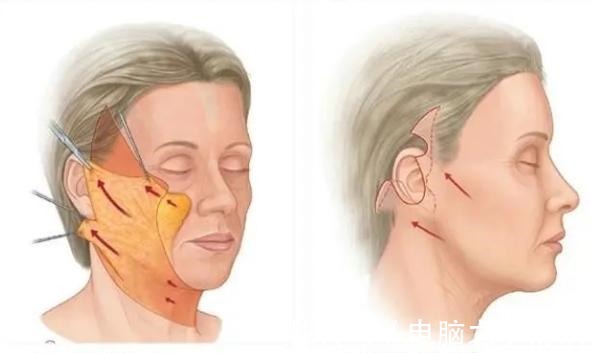 高光点 都说做拉皮手术不能太早,可我还是动心了!