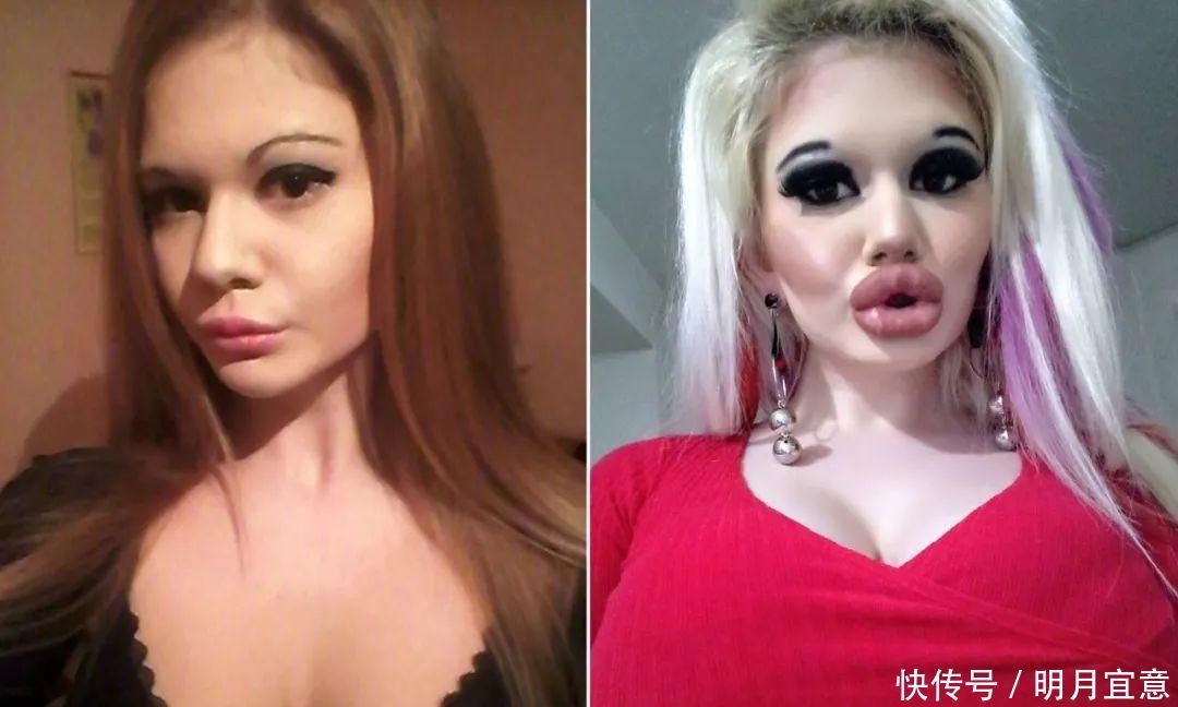 21次丰唇手术之后，这个妹子的嘴唇现在长这样…