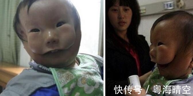 男婴|男婴出生时脸部畸形，多次孕检未检验出，专家给出这样的解释