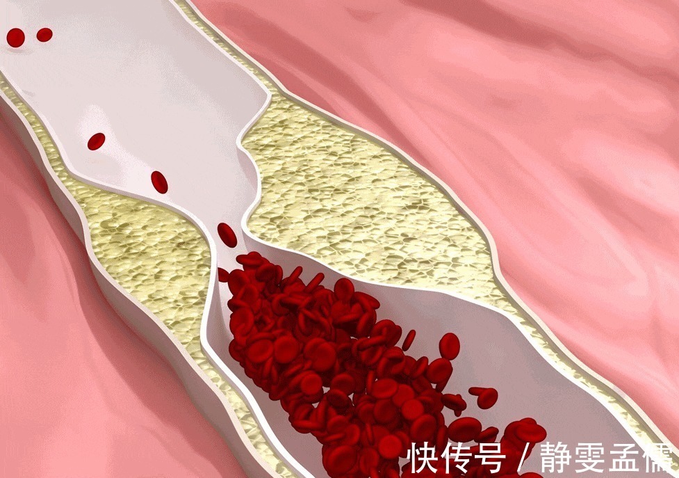 山楂|血液粘稠不用怕,3种水果,有助清理血管垃圾,巧防血栓