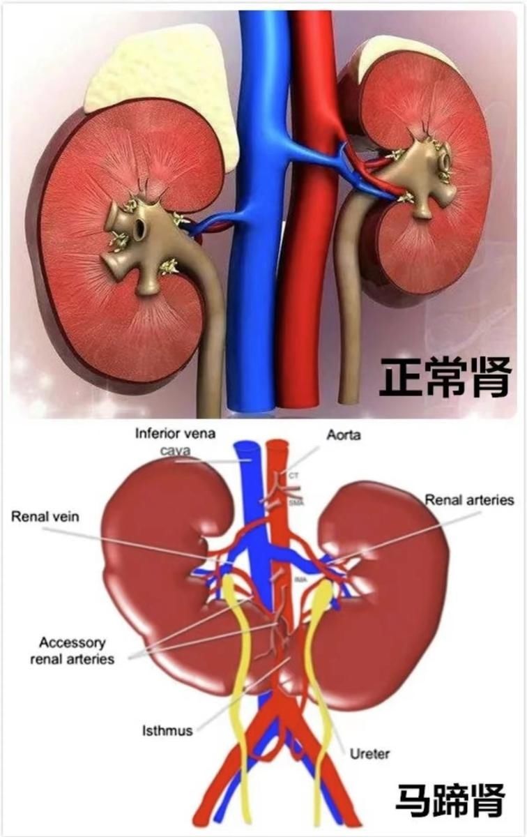 马蹄肾|【医聊科普】胎儿竟然长了一只马蹄肾！这样的胎儿还能要吗？