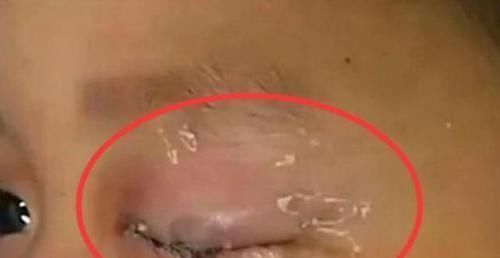 鱼刺|孩子误拿502胶水滴眼睛，妈妈30秒内的处理办法，医生都夸奖