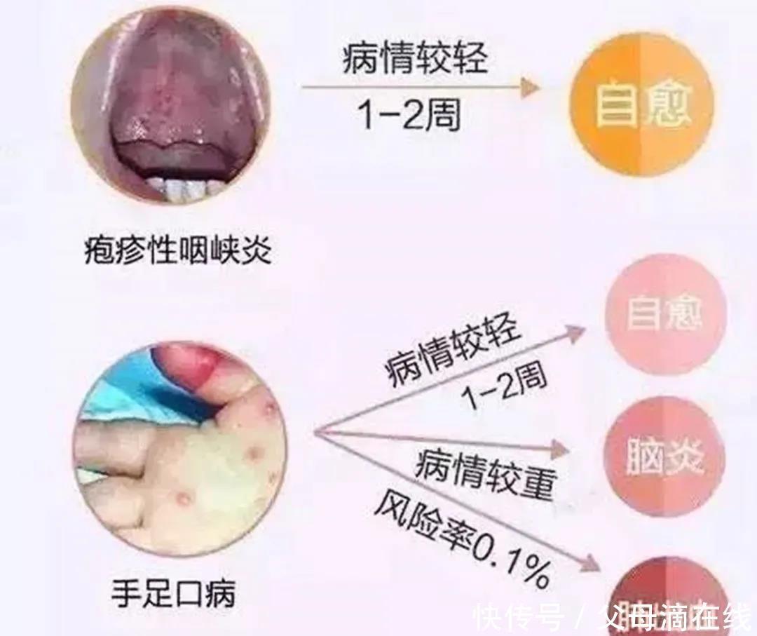 表兄弟|手足口的“表兄弟”近期来袭！病情痛苦，有娃的赶紧预防起来