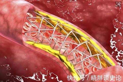 高血脂|高血脂患者，身体会有哪些表现，早了解早好