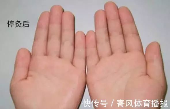 汗证|汗从哪里出，病从哪里来！夏天爱出汗的，快对照看看吧！