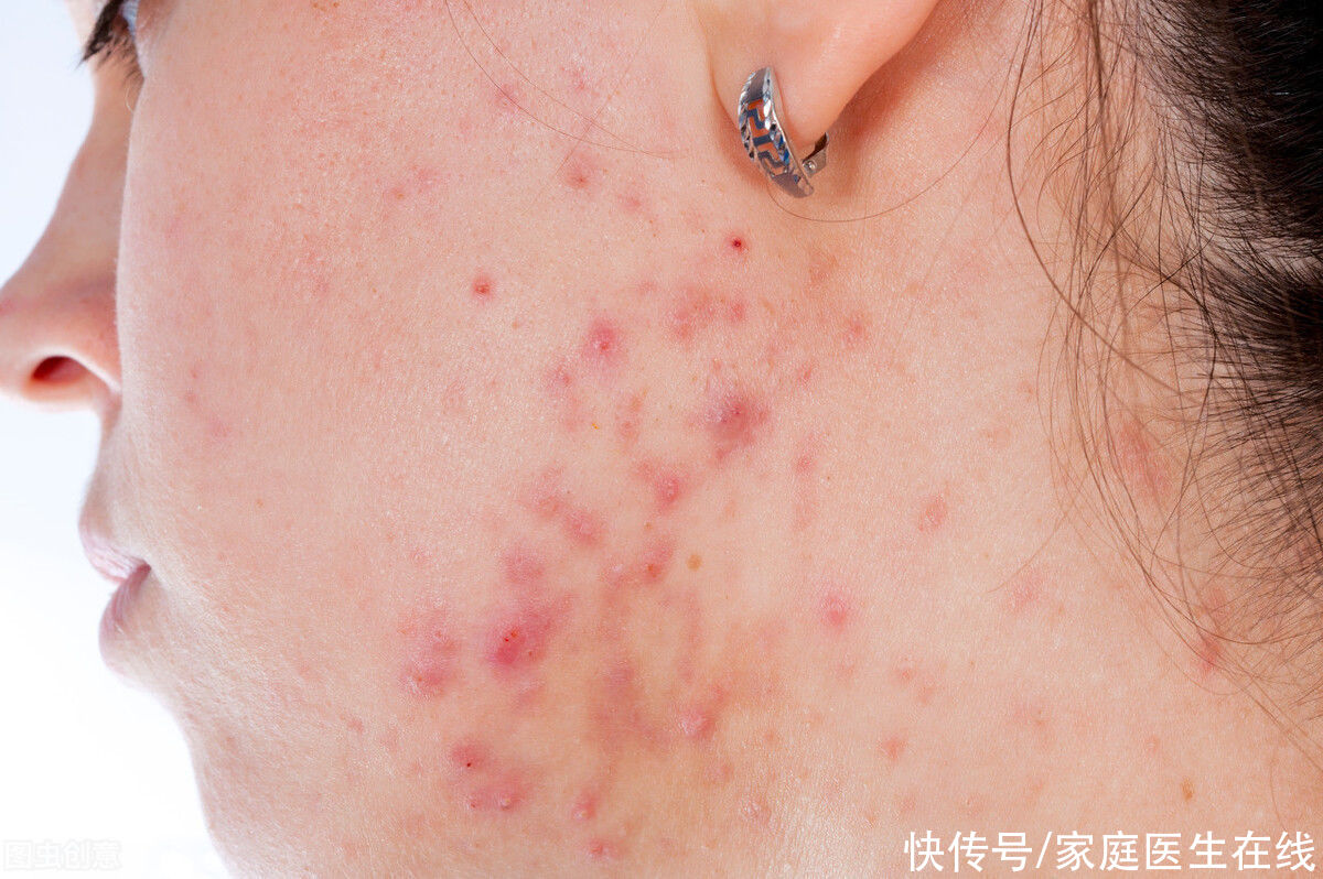  美丽|并不是所有的玫瑰都是美丽的，这些带有玫瑰字样的皮肤病最是影响人的外观